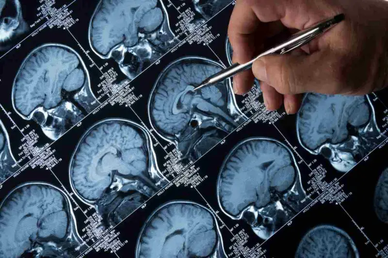 Donna sottoposta a Chemioterapia per 11 Anni per Diagnosi Errata di Tumore al Cervello