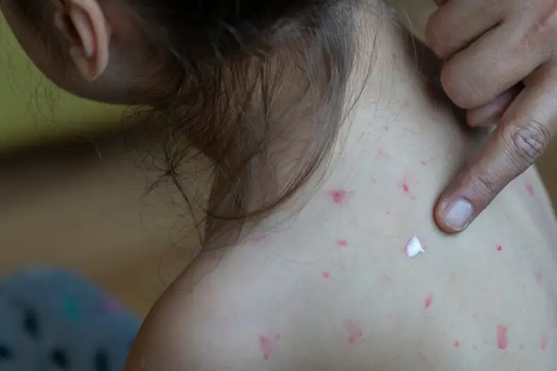 Morbillo: Crescono i Casi in Italia, Allarme degli Esperti